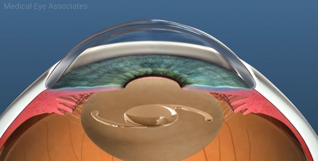 IOL Lens Implant.