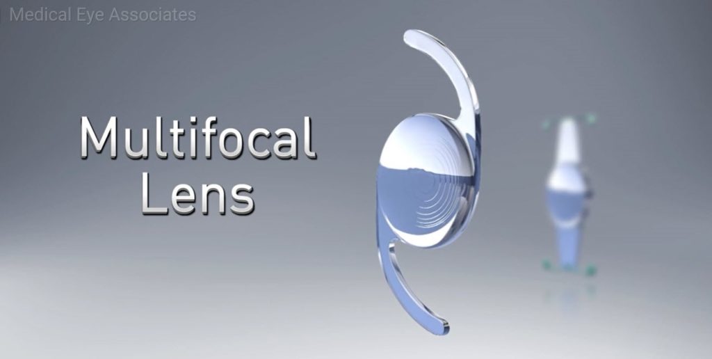 Multifocal Lens.