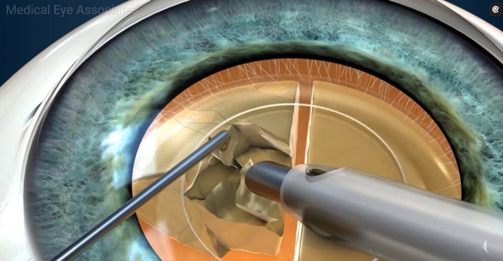 Removing cataract during surgery.