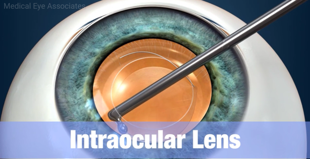 Cataract Surgery At Medical Eye Associates Medical Eye Associates 