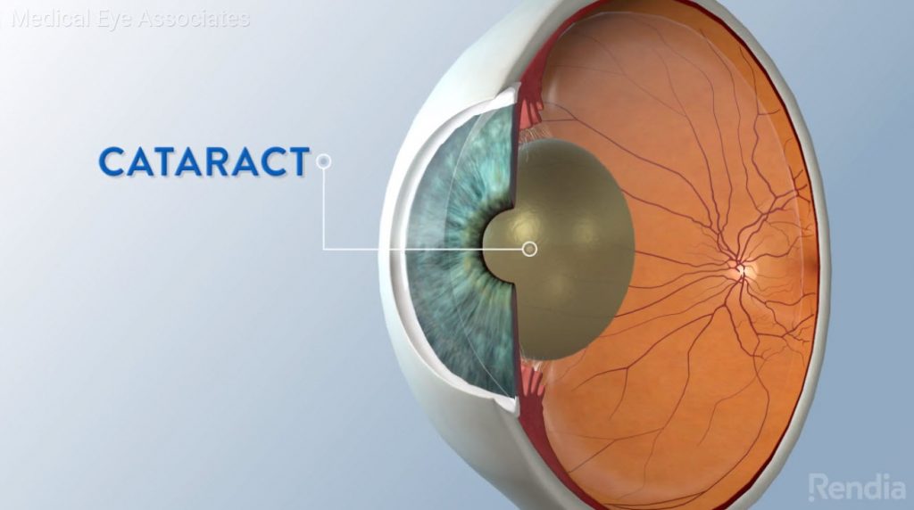 Cataract lens