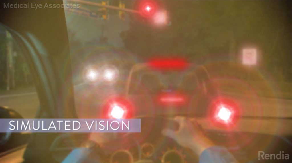 Simulated vision, driving with an eye affected by cataract