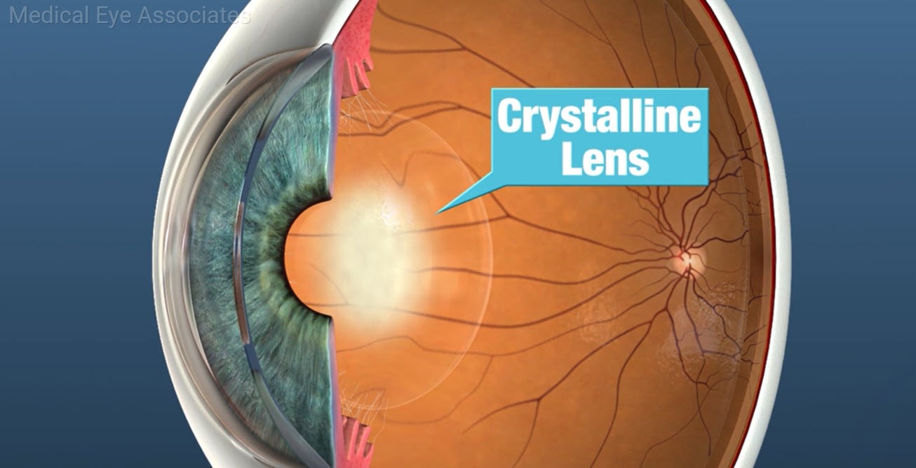 Eye affected by early stages of Cataract