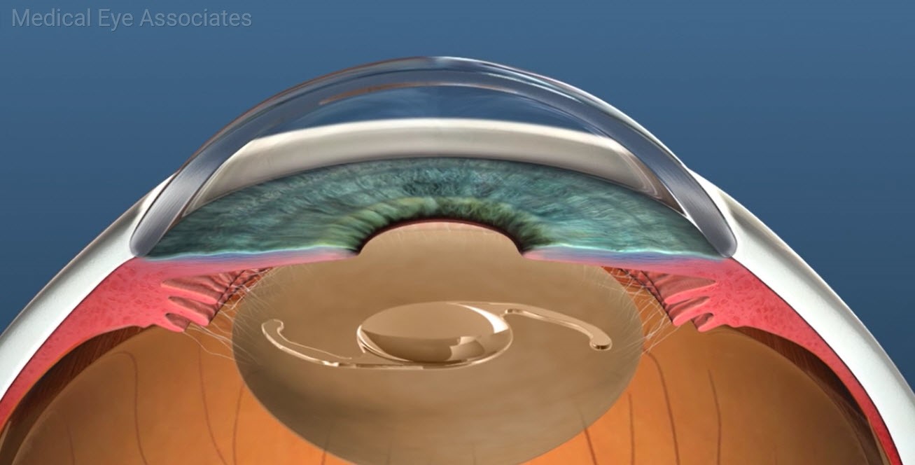 Cataract Treatment at Medical Eye Associates Medical Eye