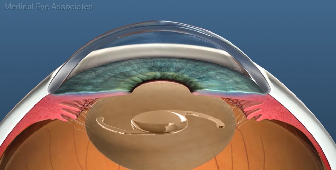 IOL Lens Implant Medical Eye Associates