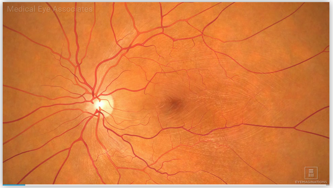 The Stages Of Macular Degeneration Medical Eye Associates   Macular Degeneration 