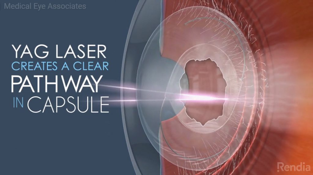 YAG Laser creates a clear pathway in capsule Medical Eye Associates